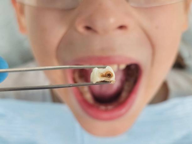Best Urgent Care for Lost Fillings or Crowns in Huber Ridge, OH